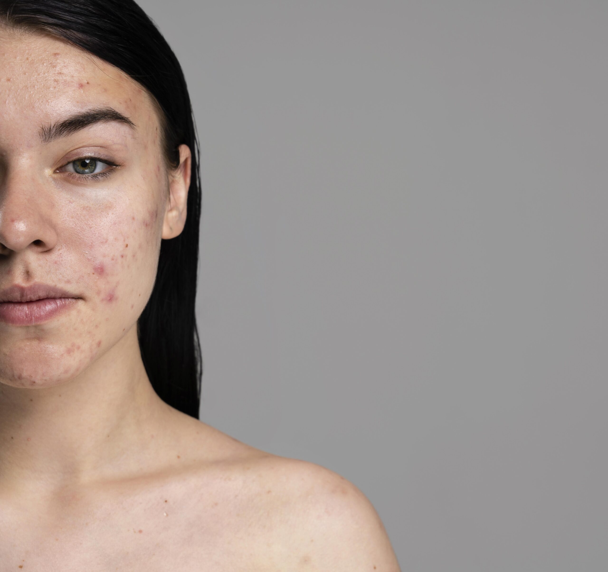 Hadri e de partea ta în lupta cu acneea